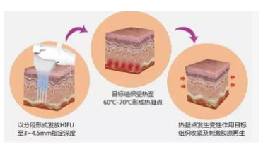 超声刀两个月